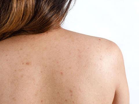 SIRTTAKİ SİVİLCELERİNİZDEN KURTULMANIZIN 6 YOLU! 1