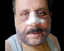 Gökhan Güney.. ESTETİK OLDU, YÜZÜNÜ YENİLEDİ!