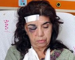 Sabahat Adalar... SETTE KÖPEKTEN KAÇARKEN, MERDİVENDEN YUVARLANDI!