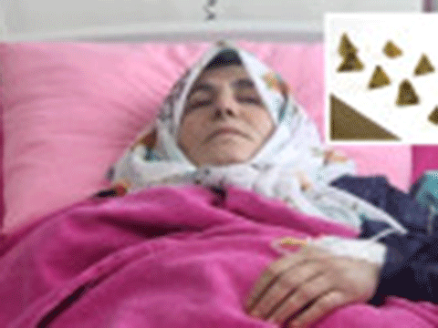 SAFRA KESESİNDEN ÇIKAN TAŞLARIN ŞEKLİ ŞAŞIRTTI!