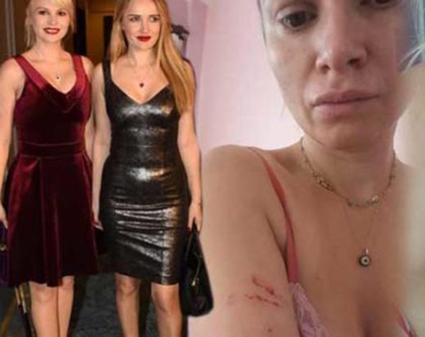 Seçkin Piriler... FENA DAYAK YEMİŞ, RESİMLERİ YAYINLADI!