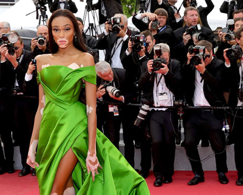 Winnie Harlow... HASTALIĞINI AVANTAJA ÇEVİRDİ!
