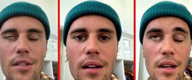 Justin Bieber... 'YÜZÜMÜN BİR KISMI TAMAMEN FELÇ!'