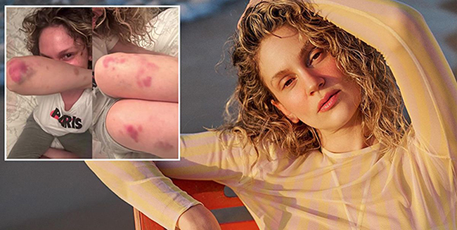 Farah Zeynep Abdullah... VÜCUDUNDAKİ MORLUKLAR KORKUTTU!